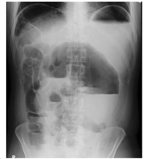 Upright Plain Abdominal X Ray Showing A Hugely Dilated Large Bowel Loop