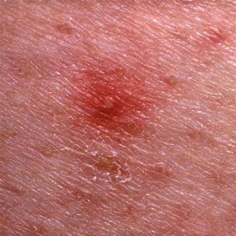 Itchy White Bumps On Skin