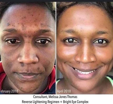 Pin On Skin Care Transformations