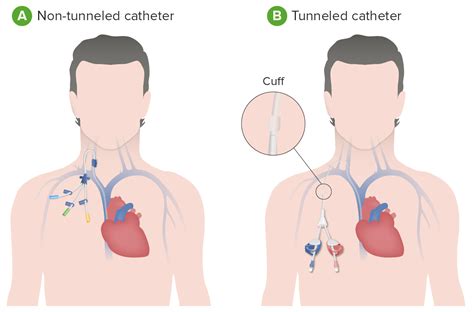 Different Types Of Dialysis Catheters
