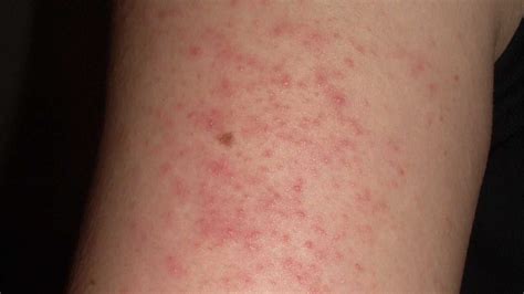 Demystifying The Link Between Keratosis Pilaris And Eczema What You