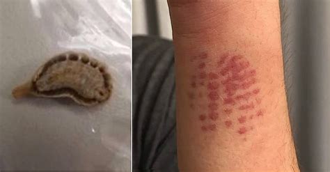 Mom Shares Warning After Teen Is Stung By Deadly Caterpillar
