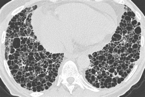 Ct Features Of The Usual Interstitial Pneumonia Pattern