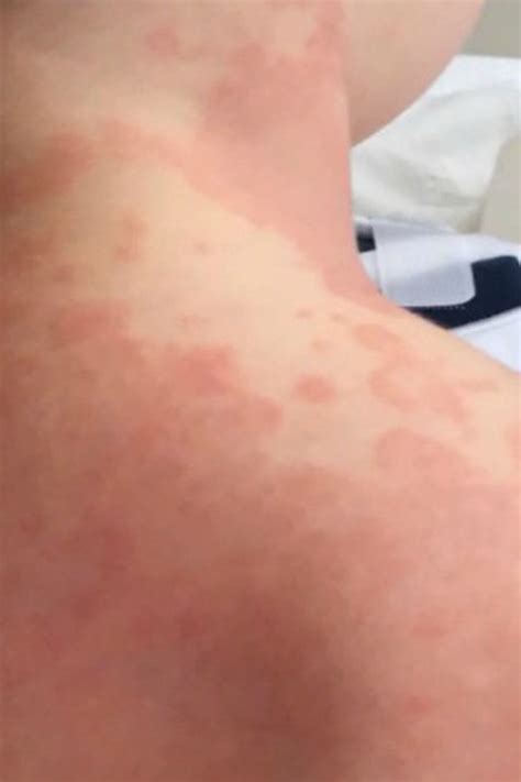 Covid Rash In Kids Coronavirus Symptoms Skin Rash Could A Prominent