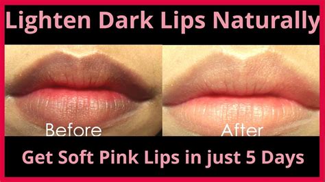 How To Get Rid Of Black Lips In Just 2 Dayslighten Dark Lips Naturally
