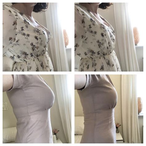 My Breast Reduction Story And A Dear Thank You To Everyone On This Sub Rreduction