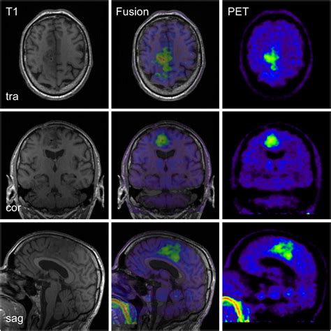 Hybrid Petmri Of Intracranial Masses Initial Experiences And