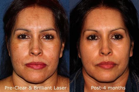Clear And Brilliant San Diego Ca Cosmetic Laser Dermatology
