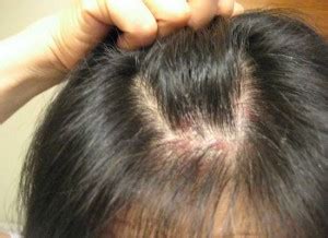 Would Any Stage Of Scalp Psoriasis Cause Hair Loss Myrujukan