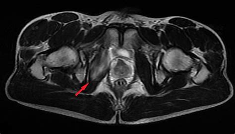 Obturator Internus Bursa MRI