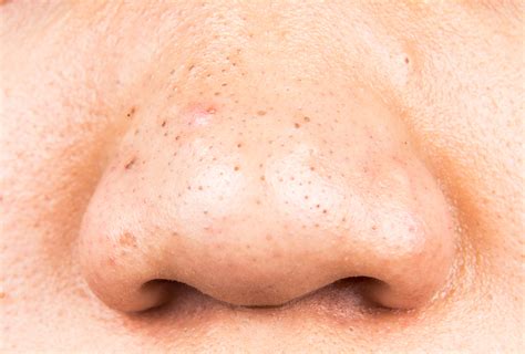 How To Get Rid Of Blackheads At Home Emedihealth