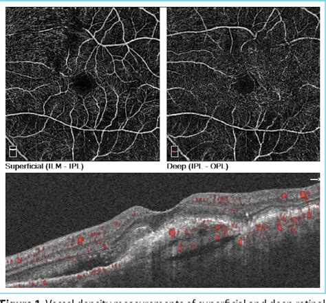 Figure 1 From Comparison Of Optical Coherence Angiography Measurements
