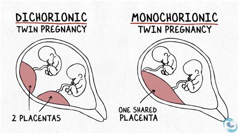 The Difference Between Dichorionic And Monochorionic Twins Broadcastmed