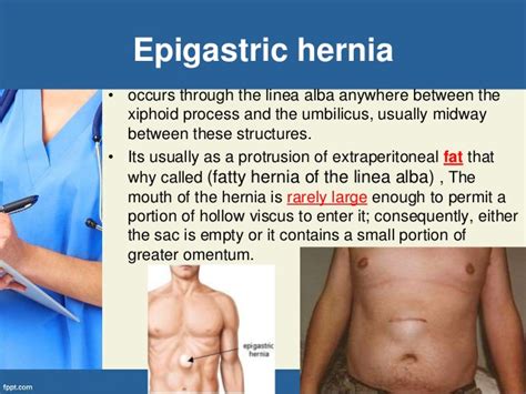 Hernia Symptoms Abdomen Hiatal Hernia Types Of Hernia Treatment