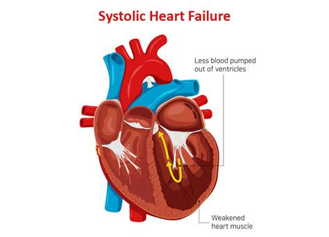 What Ar Systolic Heart Failure Symptoms And Treatment Dr Raghu