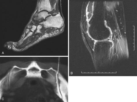 Psoriatic Arthritis Musculoskeletal Key