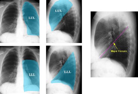 Lung Anatomy Wikiradiography