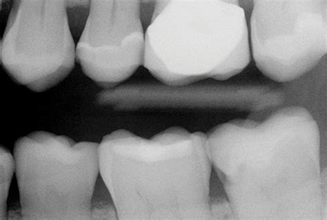 Diagnostic Challenges Of Dental Radiographs And Adjunctive Methods Of