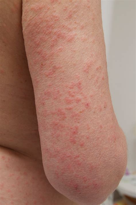 What does a food allergy rash look like. What Does a Sun Poisoning Rash Look Like? - Sun Poisoning ...