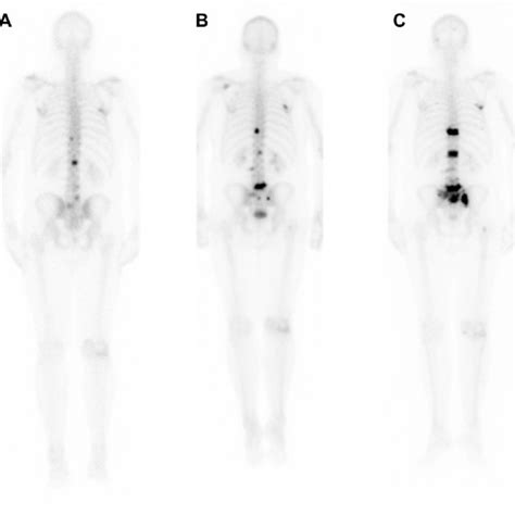 Bone Scintigraphy Bs Shows Metastatic Bone Disease Progression