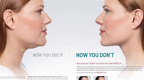 What Is The Kybella Double Chin Fat Removal Procedure Youtube