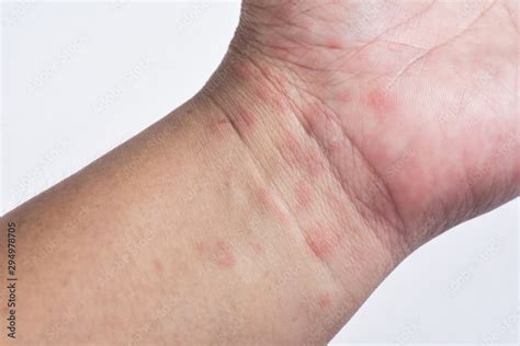 Red Allergic Rash From Atopic Dermatitis On The Wrist Stock Photo