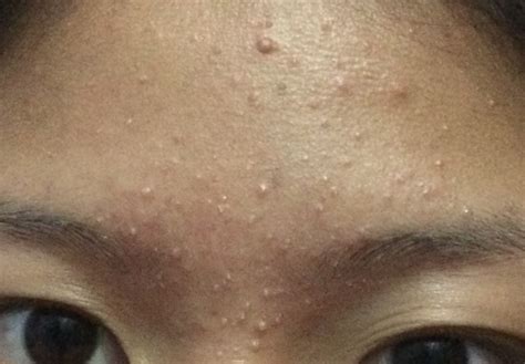 How To Get Rid Of Whiteheads On Forehead General Acne Discussion