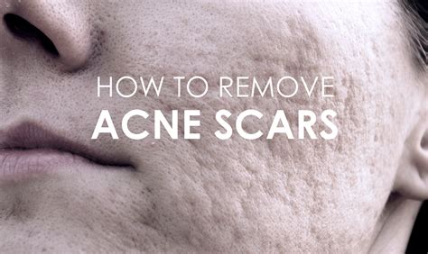 What Are Acne Scars And How To Get Rid Of Them Premier Clinic