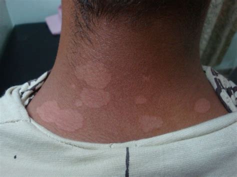Can i use nizoral cream with other medicines? Ketoconazole for Pityriasis aka Tinea Versicolor and ...