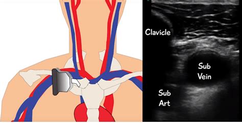 The Subclavian Line The Resuscitation Line Of Champions — Downeast