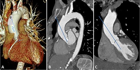 Frontiers Minireview Transaortic Transcatheter Aortic Valve