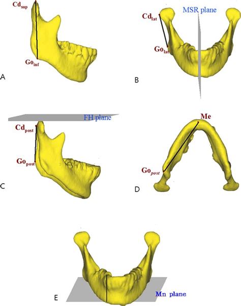 the three dimensional morphology of mandible and glenoid fossa as contributing factors to menton