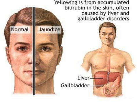 Solution What Is Jaundice Sign And Symptoms Of Jaundice Its Causes