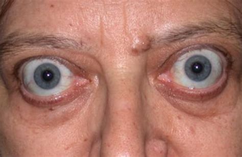 Graves Disease Thyroid Eye Disease Dr Francesco Bernardini