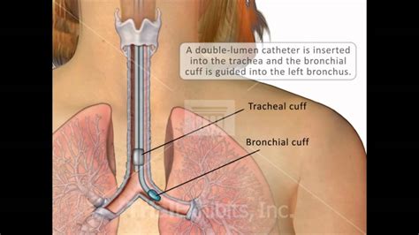 Double Lumen Catheter Intubation Medical Animation Youtube
