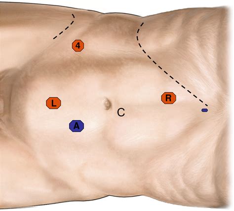 Initial Series Of Robot Assisted Laparoscopic Retroperitoneal Lymph