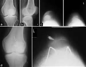 Trochleoplasty And Medial Patellofemoral Ligament Reconstruction For