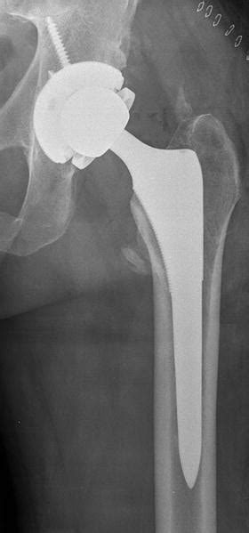 Dislocation After Total Hip Arthroplasty Musculoskeletal Key