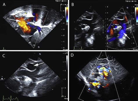 Echocardiogram Images A Subcostal Sagittal Plane Bicaval View With