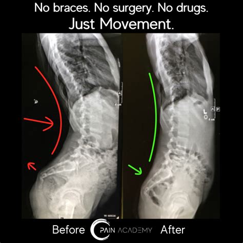 Lordosiskyphosis X Ray Results Pain Academy