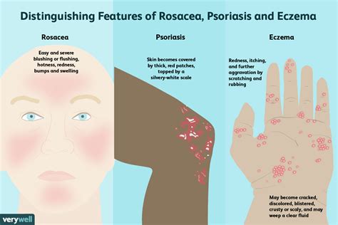 Acne Prone Skin Meaning In Tamil Acne Symptoms
