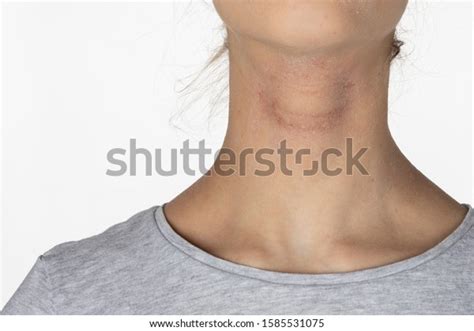 Allergic Itchy Skin On Girl Neck Stock Photo 1585531075 Shutterstock