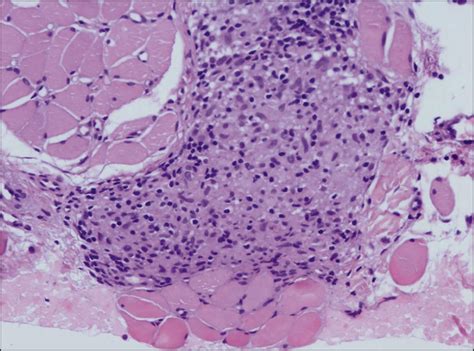 Isolated Sarcoidal Granulomas On The Tongue Dermatology Jama