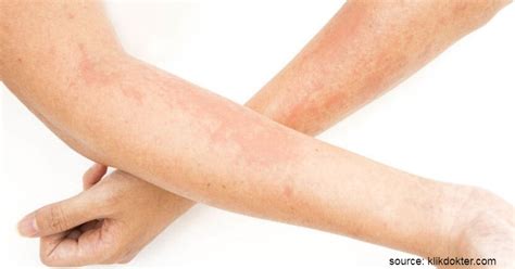 Namun, umumnya gejala alergi akan memengaruhi kondisi kulit. Jenis-jenis Alergi pada Kulit Beserta Gejala dan Cara ...