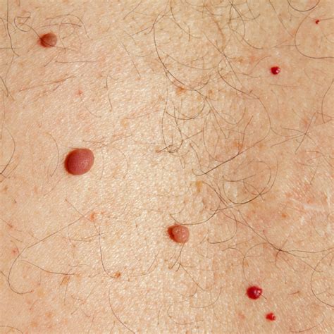 Understanding Cherry Angiomas Causes And Treatment Options