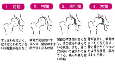 変形性膝・股関節症の治療方針方法｜佐久市立国保浅間総合病院