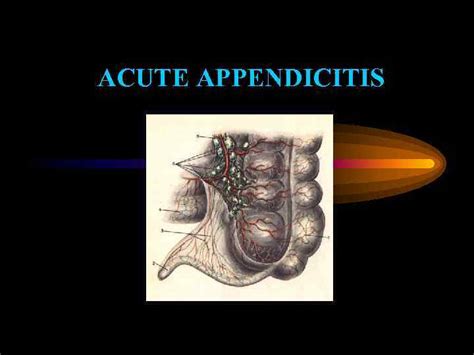 Acute Appendicitis Acute Appendicitis Is An Inflammation