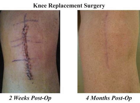Learn how i massagee the knee and the scar. Condition_Scars