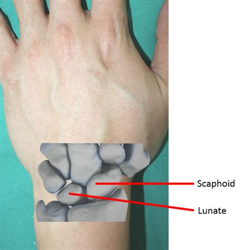 Radial Sided Wrist Pain The Scapholunate Ligament Injury Mount