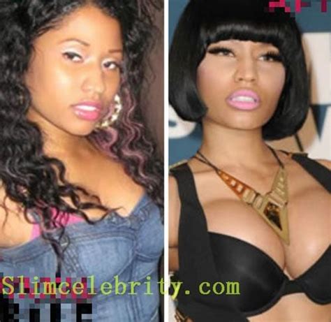 Celebrity Nicki Minaj Breast Implants Before After Celeb Surgerycom